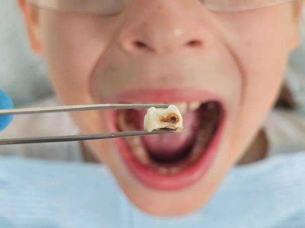 Best Emergency Root Canal Treatment in Sheldon, IL